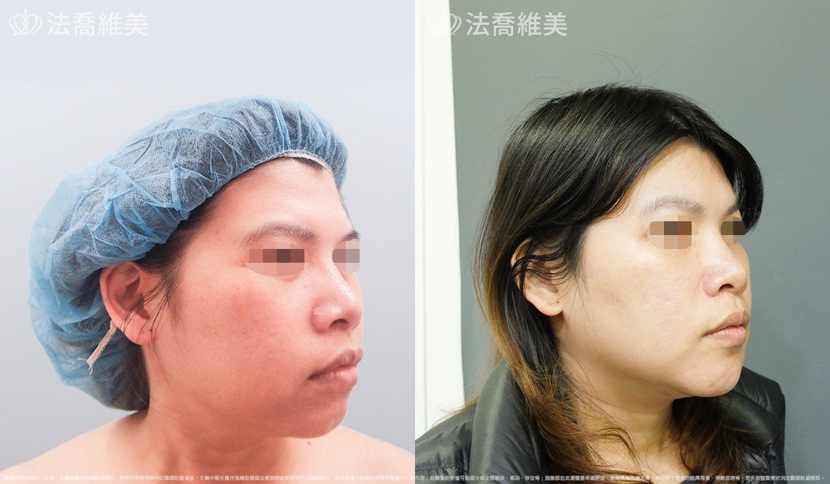 人工骨下巴,法喬醫美診所,邱浚彥