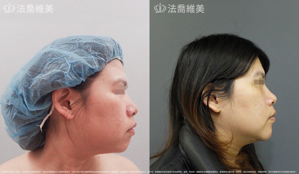 人工骨下巴,法喬醫美診所,邱浚彥