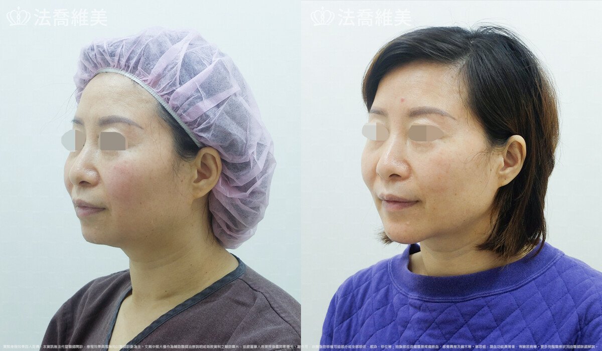 人工骨下巴,法喬醫美診所,邱浚彥