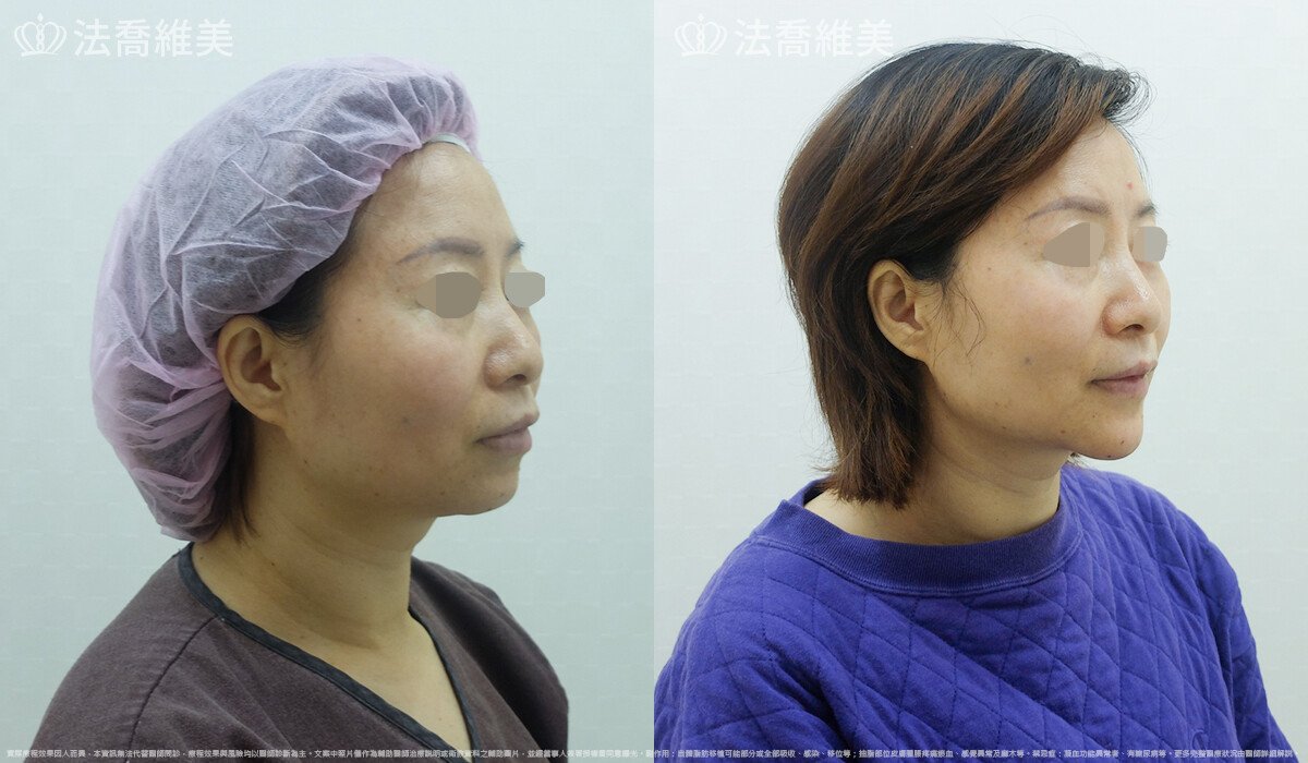 人工骨下巴,法喬醫美診所,邱浚彥