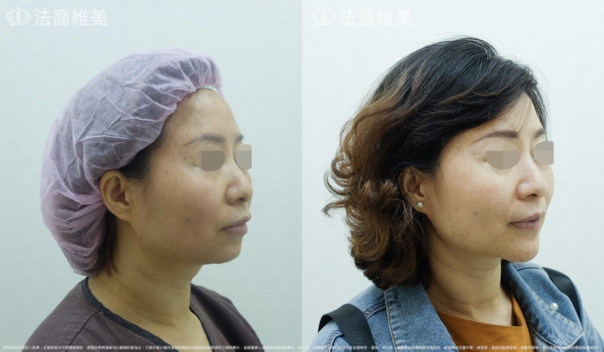 人工骨下巴,法喬醫美診所,邱浚彥