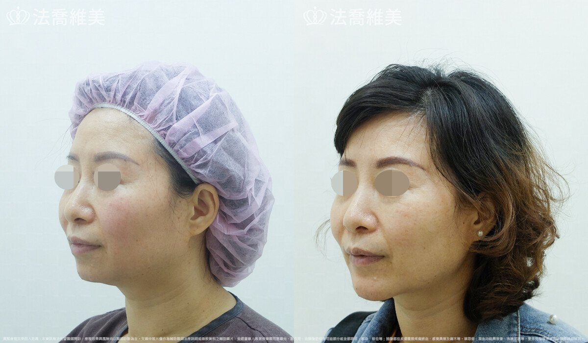 人工骨下巴,法喬醫美診所,邱浚彥
