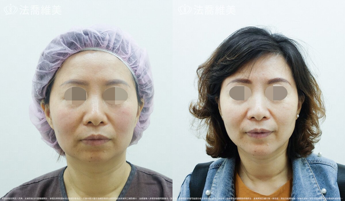 人工骨下巴,法喬醫美診所,邱浚彥