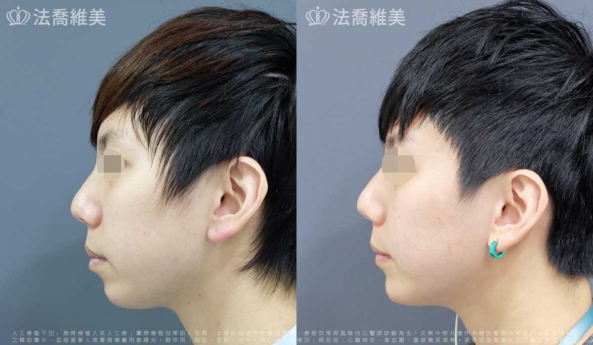 下巴手術推薦