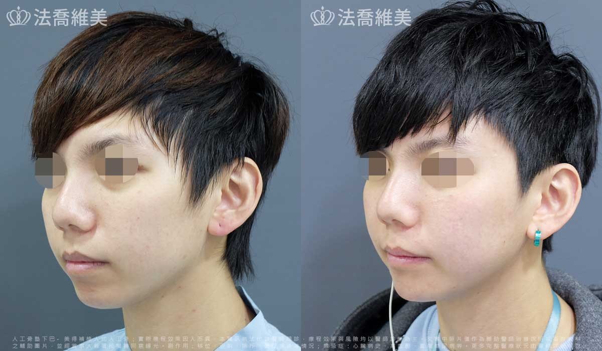 人工骨墊下巴
