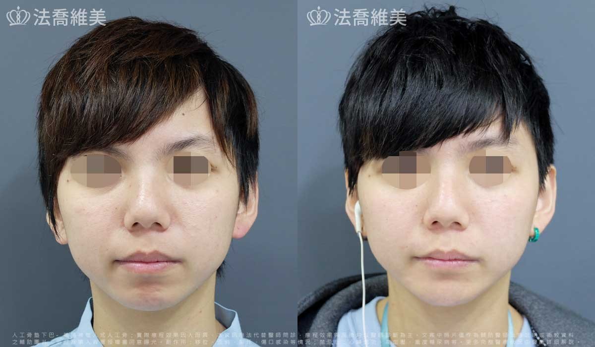 下巴增長