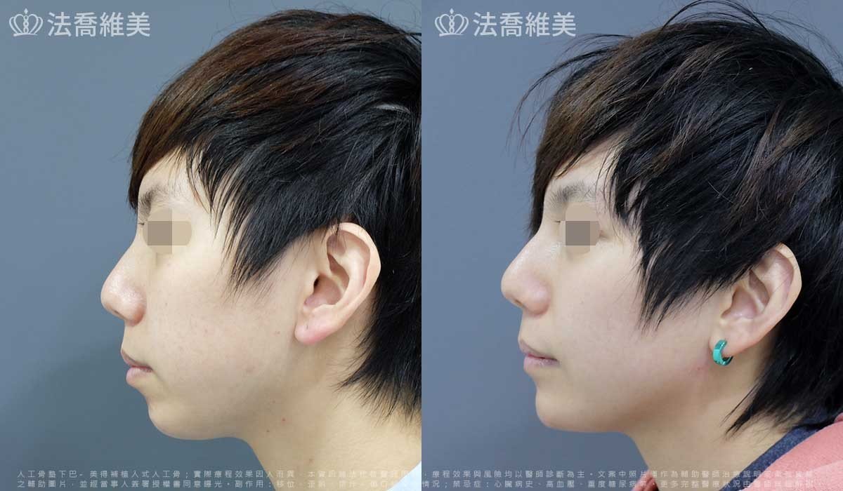 墊下巴手術