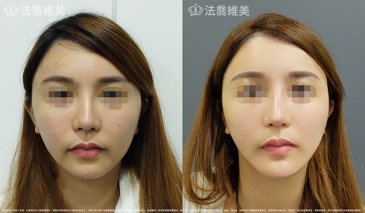人工骨下巴,法喬醫美診所,邱浚彥