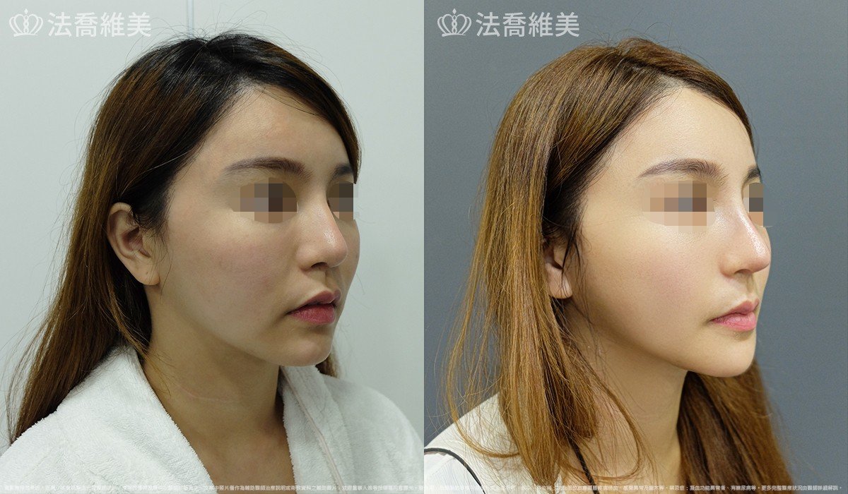 人工骨下巴,法喬醫美診所,邱浚彥