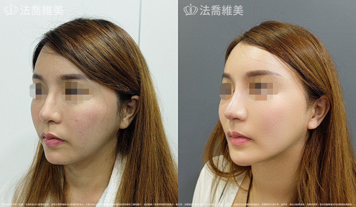 人工骨下巴,法喬醫美診所,邱浚彥