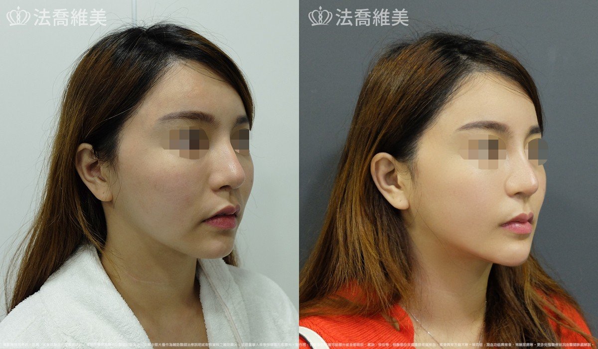 人工骨下巴,法喬醫美診所,邱浚彥