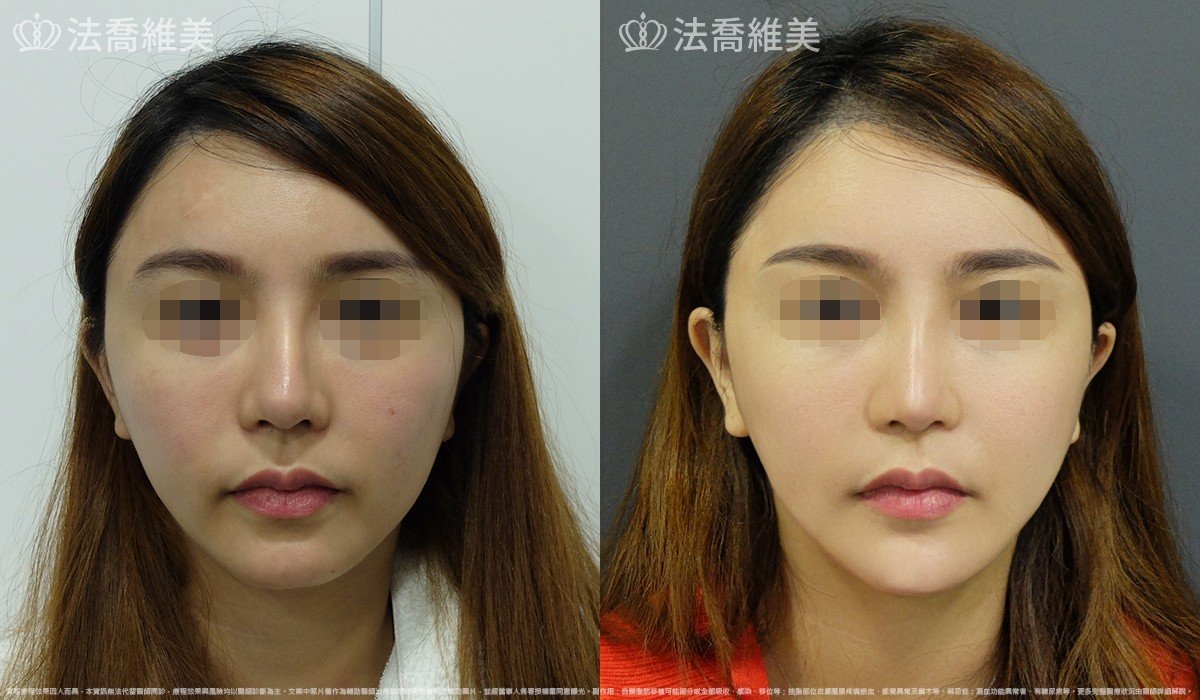 人工骨下巴,法喬醫美診所,邱浚彥