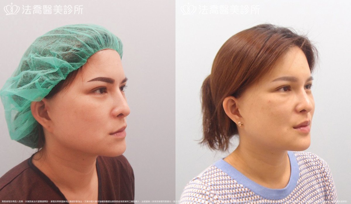 法喬醫美診所,邱浚彥,下顎角削骨