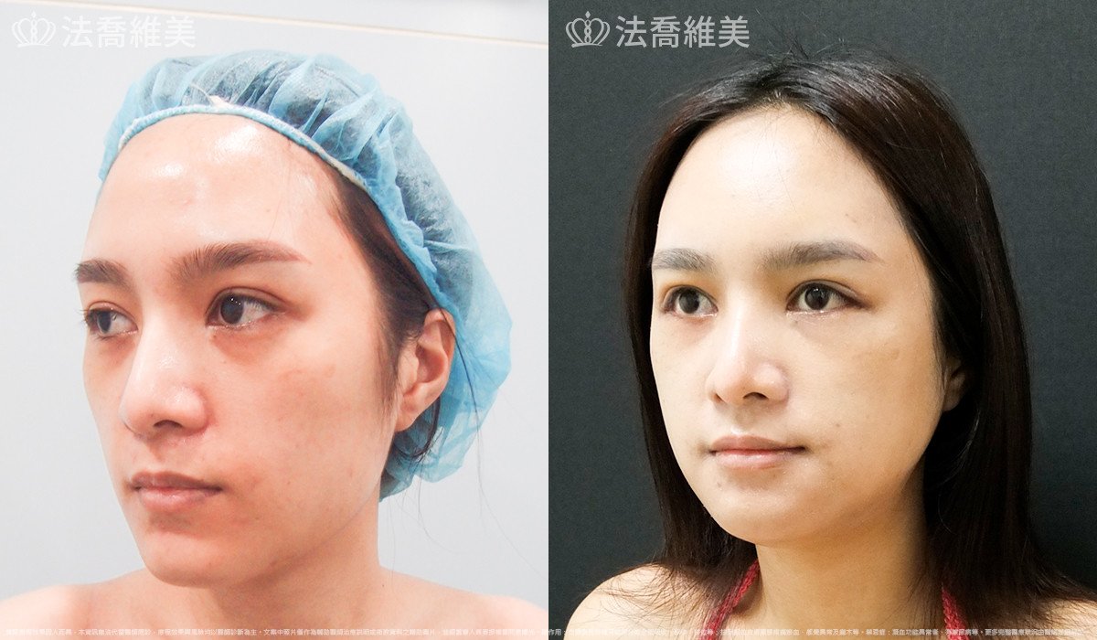 法喬醫美診所,邱浚彥,下顎角削骨