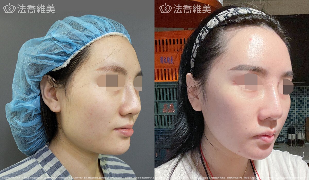 法喬醫美診所,邱浚彥,下顎角削骨