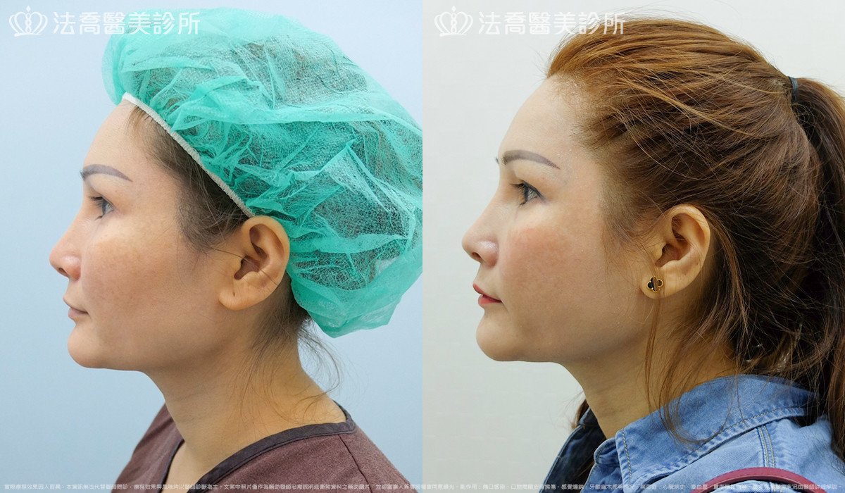 法喬醫美診所,邱浚彥,削骨