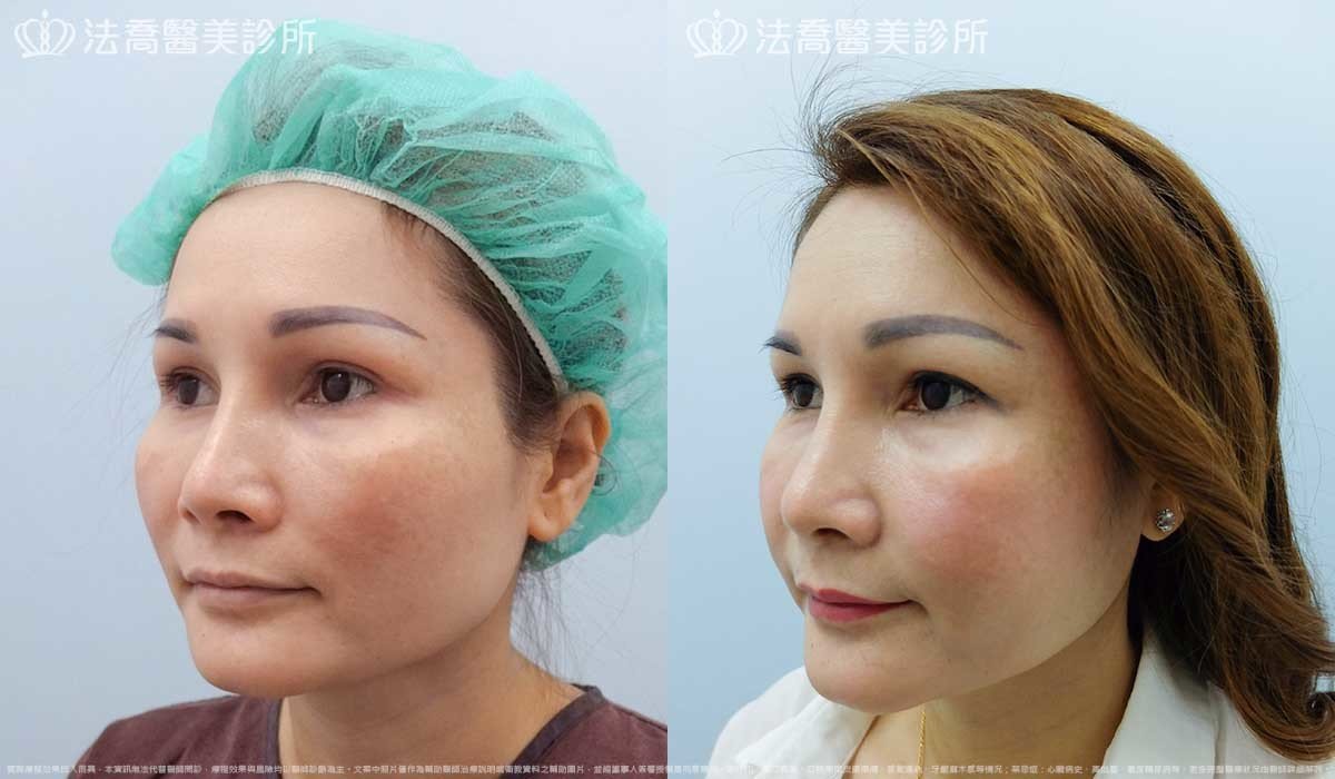 法喬醫美診所,邱浚彥,削骨