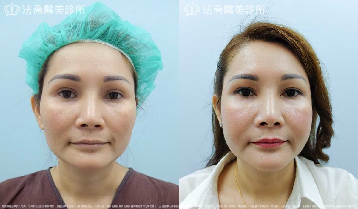 法喬醫美診所,邱浚彥,削骨