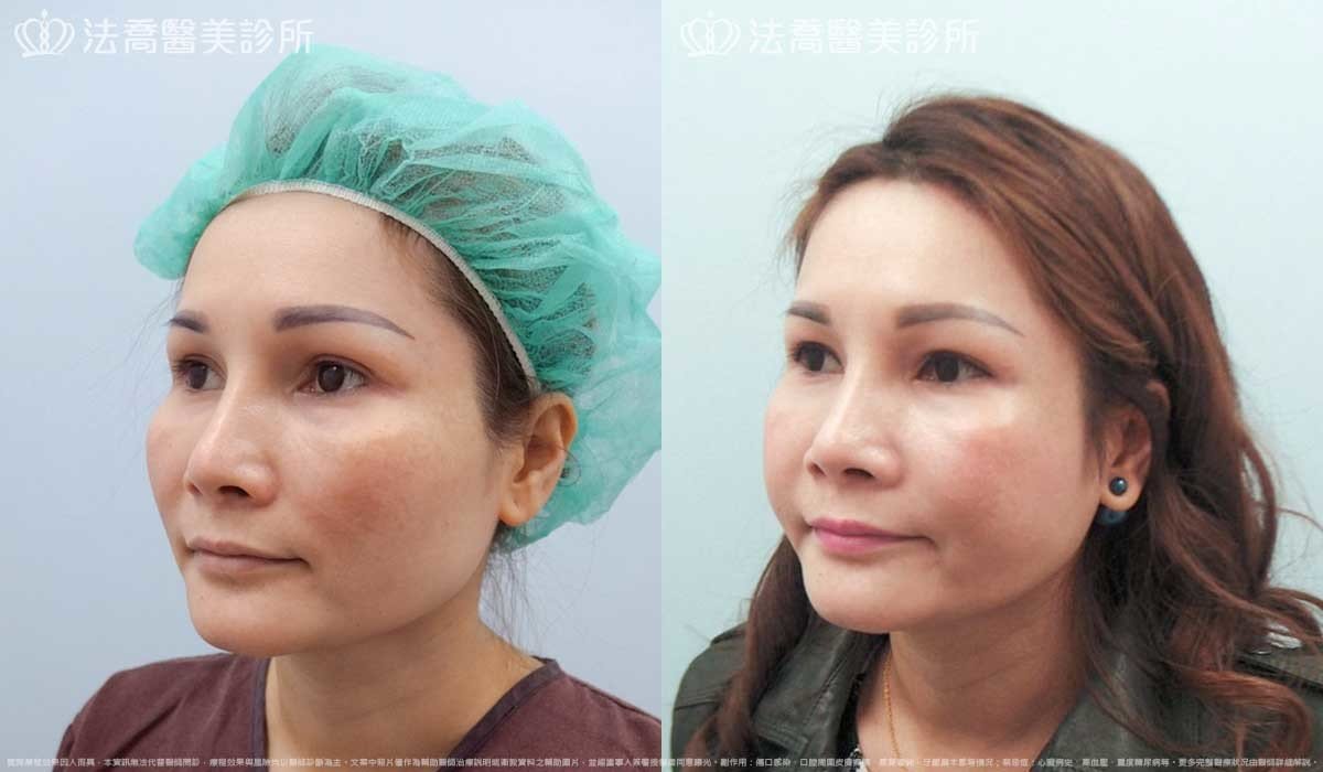 法喬醫美診所,邱浚彥,削骨