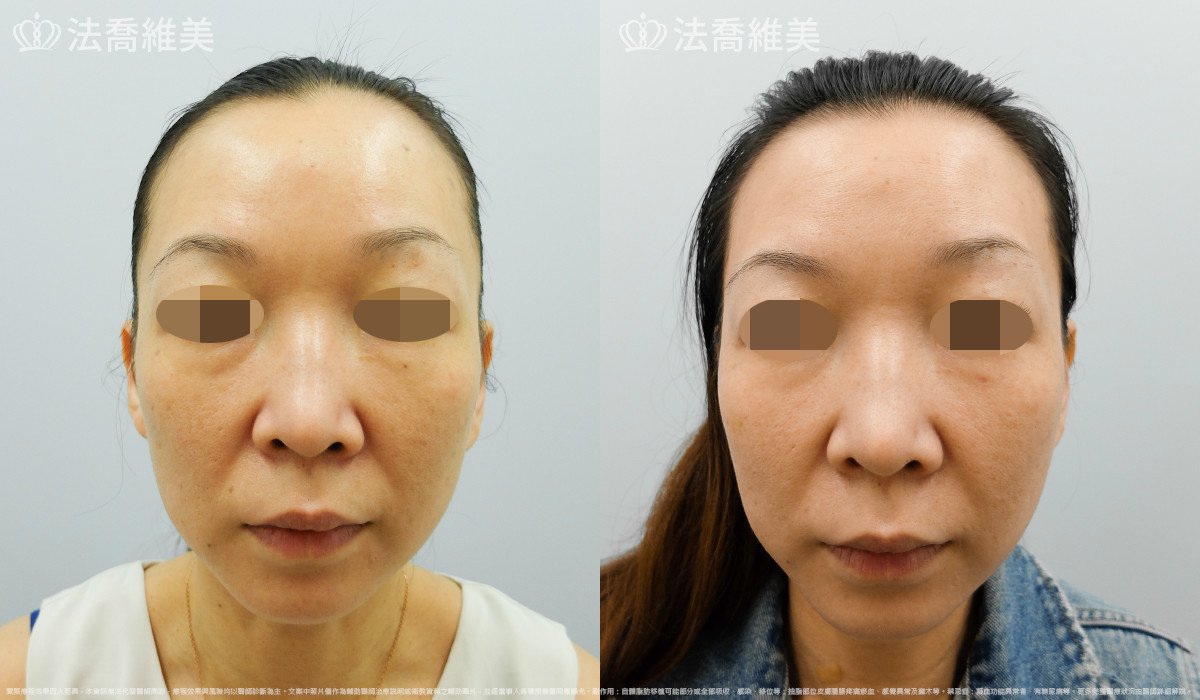 洢蓮絲填補蘋果肌,法喬醫美診所,邱浚彥