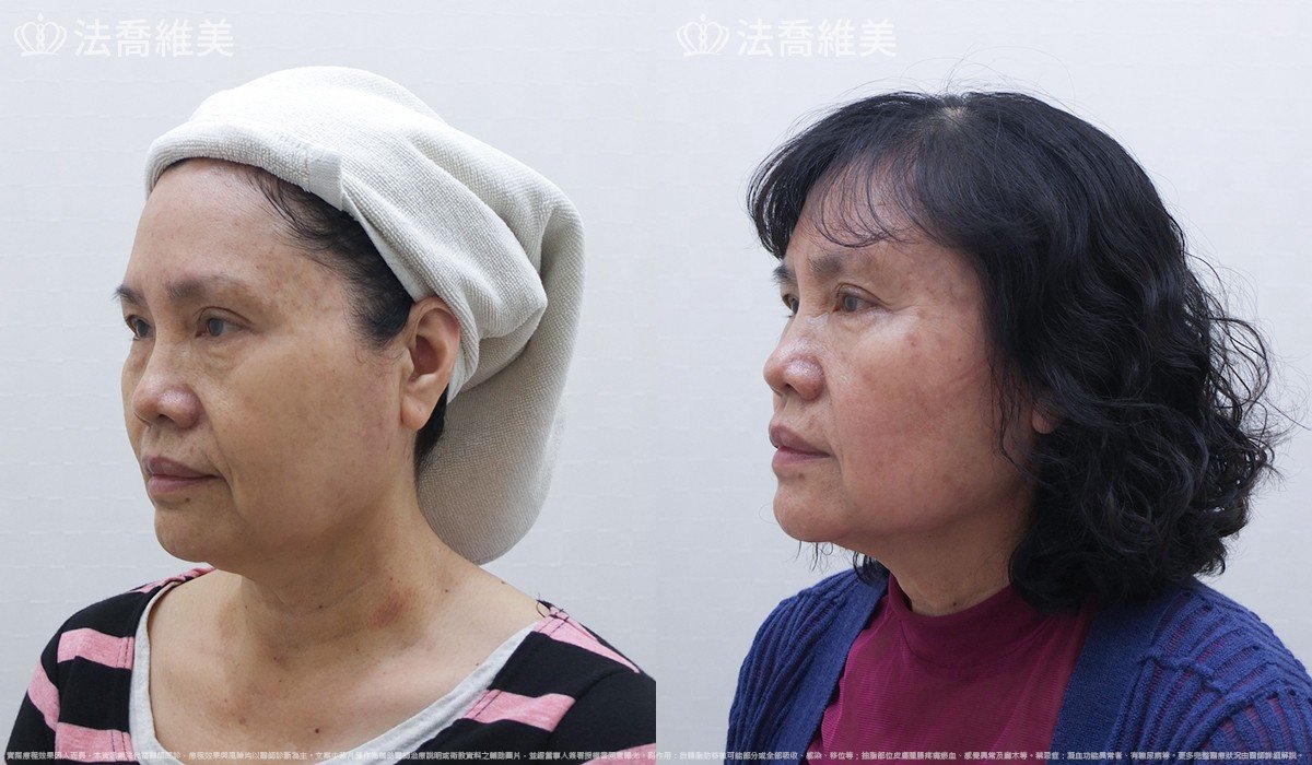 艾麗斯皮下填補劑