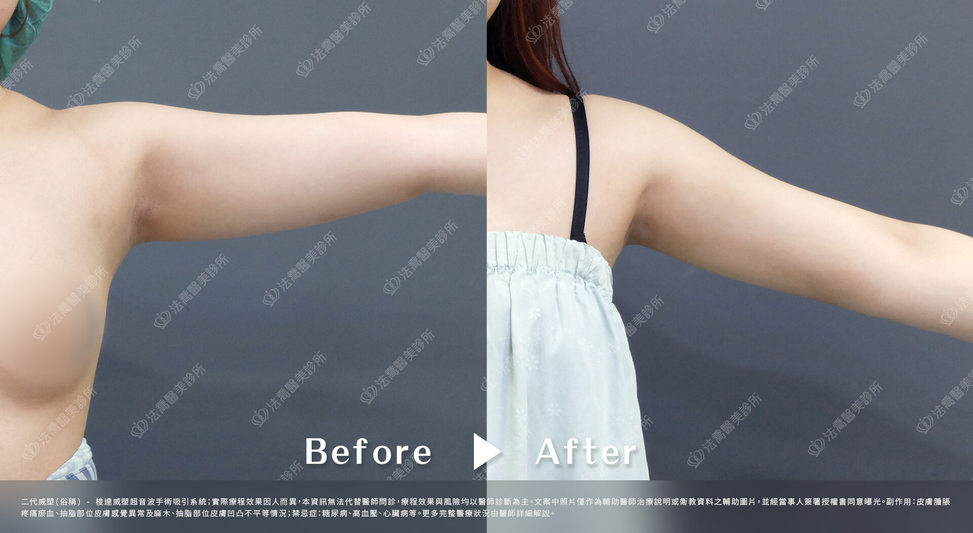 法喬醫美診所,威塑手臂環抽