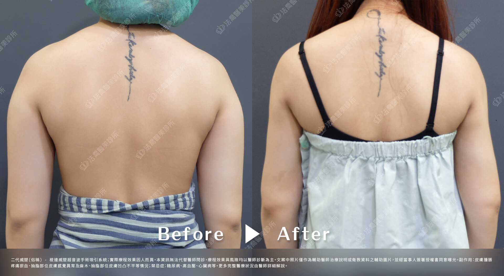 法喬醫美診所,威塑(俗稱)手臂環抽