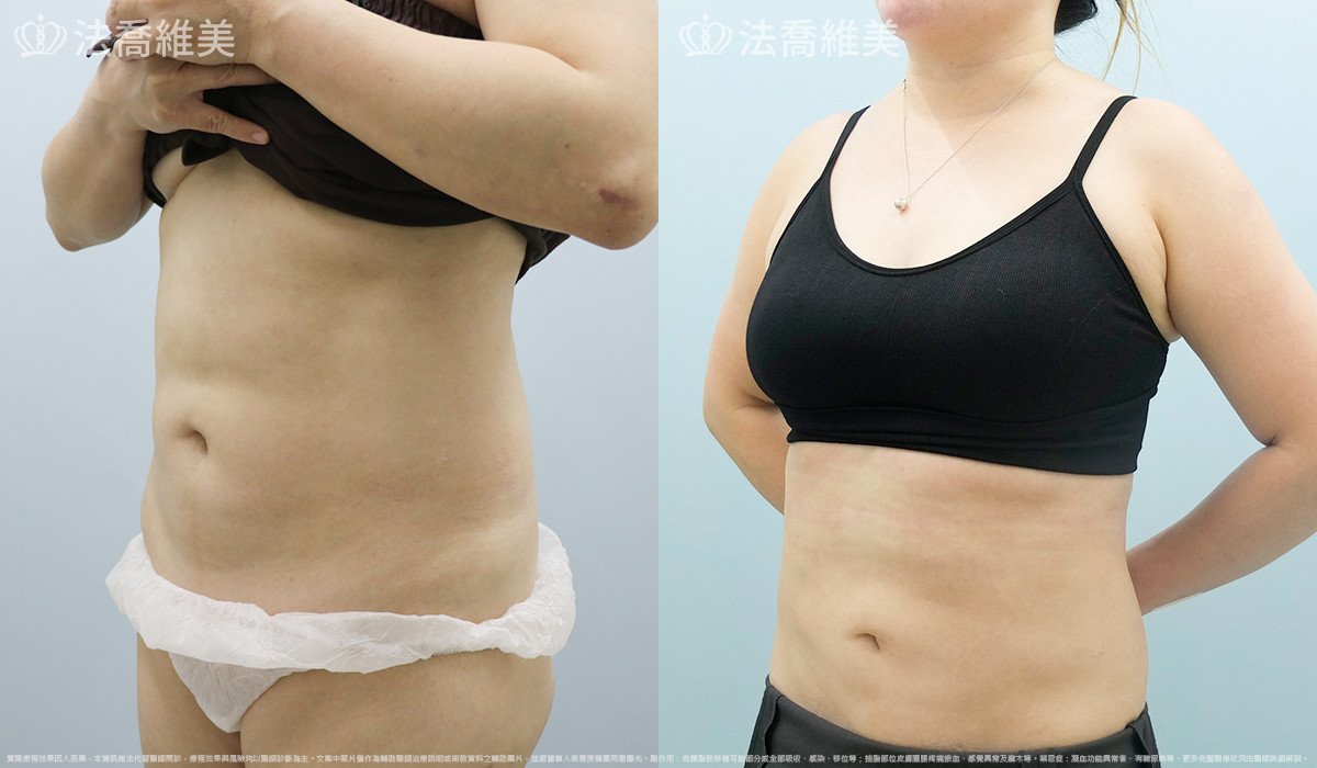 goretex隆鼻,法喬醫美診所,邱浚彥