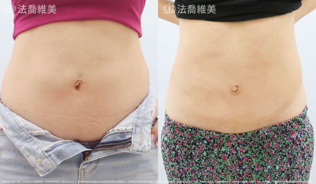威塑腹部抽脂,法喬醫美診所,邱浚彥