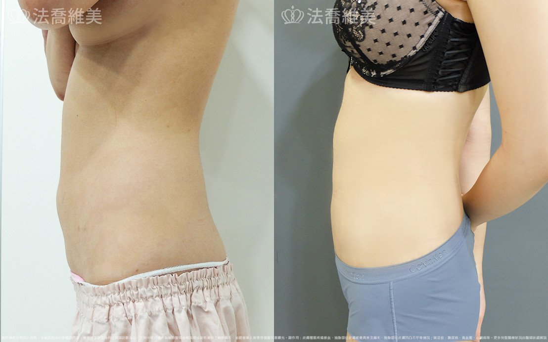 威塑腹部抽脂,法喬醫美診所,邱浚彥