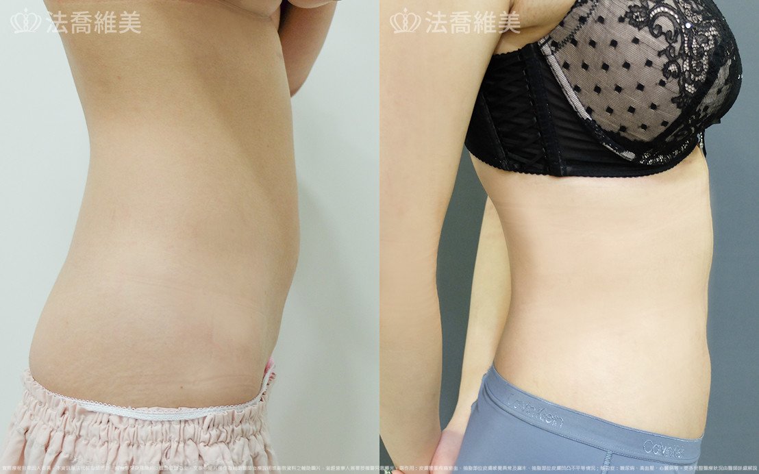 威塑腹部抽脂,法喬醫美診所,邱浚彥