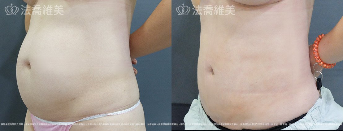 威塑腹部抽脂,法喬醫美診所,邱浚彥