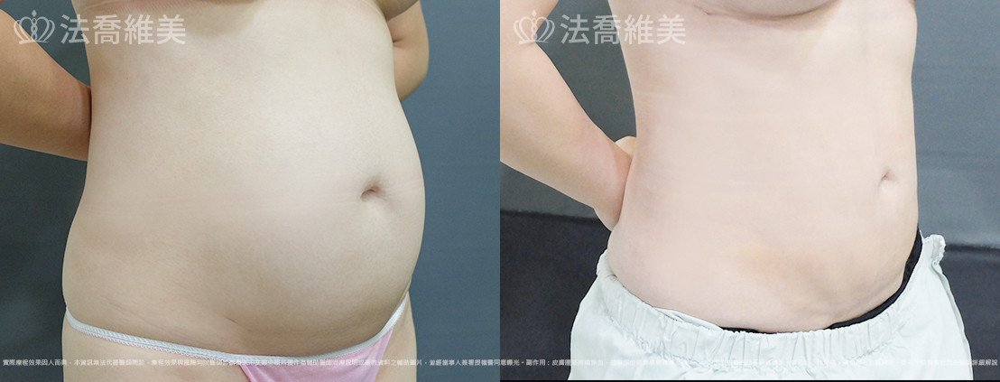 威塑腹部抽脂,法喬醫美診所,邱浚彥