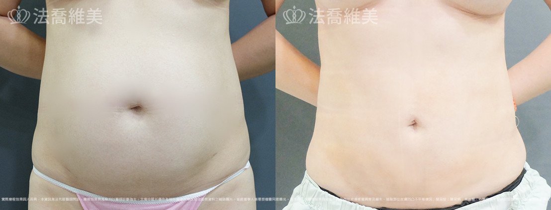 威塑腹部抽脂,法喬醫美診所,邱浚彥