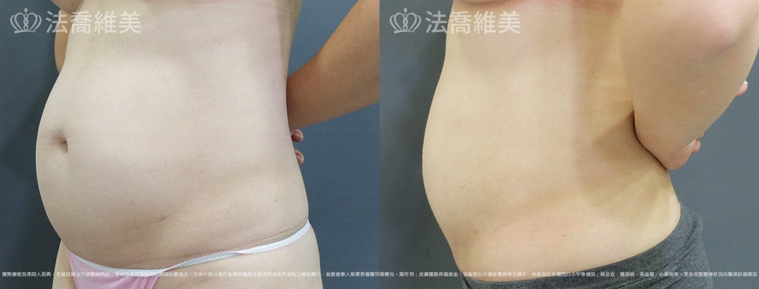 威塑腹部抽脂,法喬醫美診所,邱浚彥