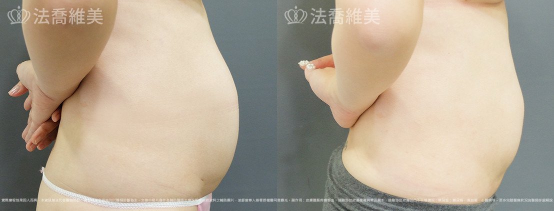 威塑腹部抽脂,法喬醫美診所,邱浚彥