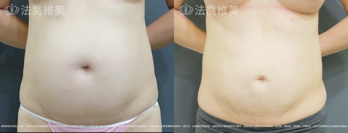 威塑腹部抽脂,法喬醫美診所,邱浚彥
