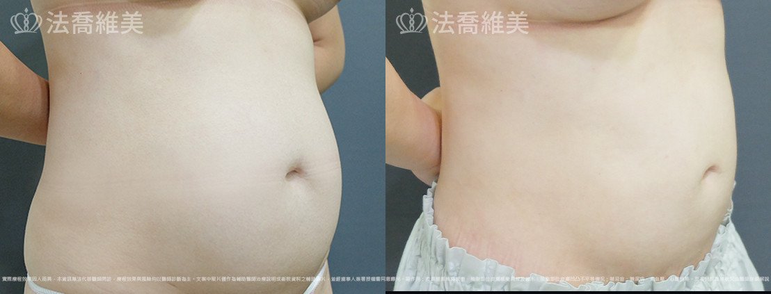 威塑腹部抽脂,法喬醫美診所,邱浚彥