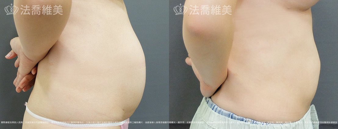 威塑腹部抽脂,法喬醫美診所,邱浚彥