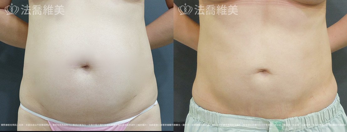 威塑腹部抽脂,法喬醫美診所,邱浚彥