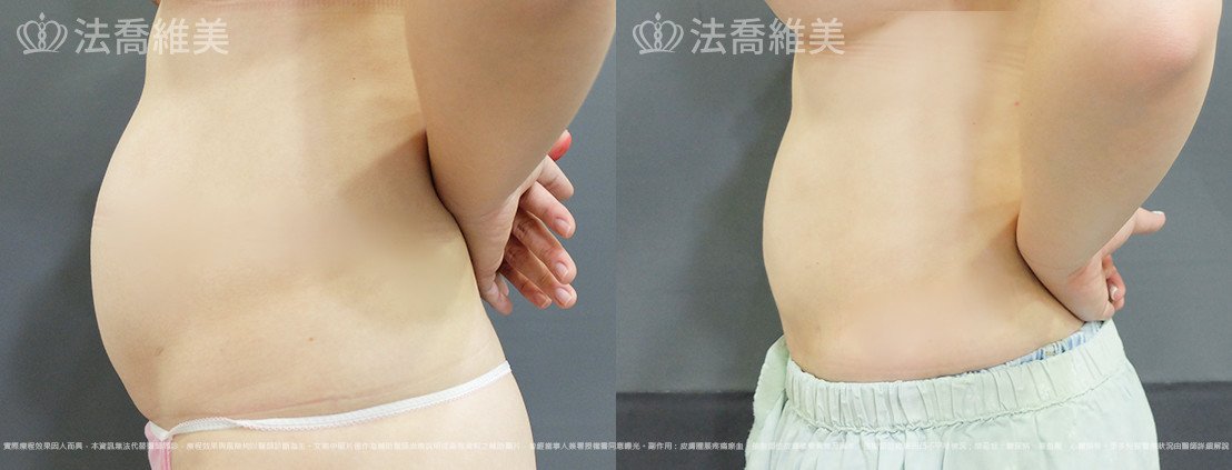 威塑腹部抽脂,法喬醫美診所,邱浚彥