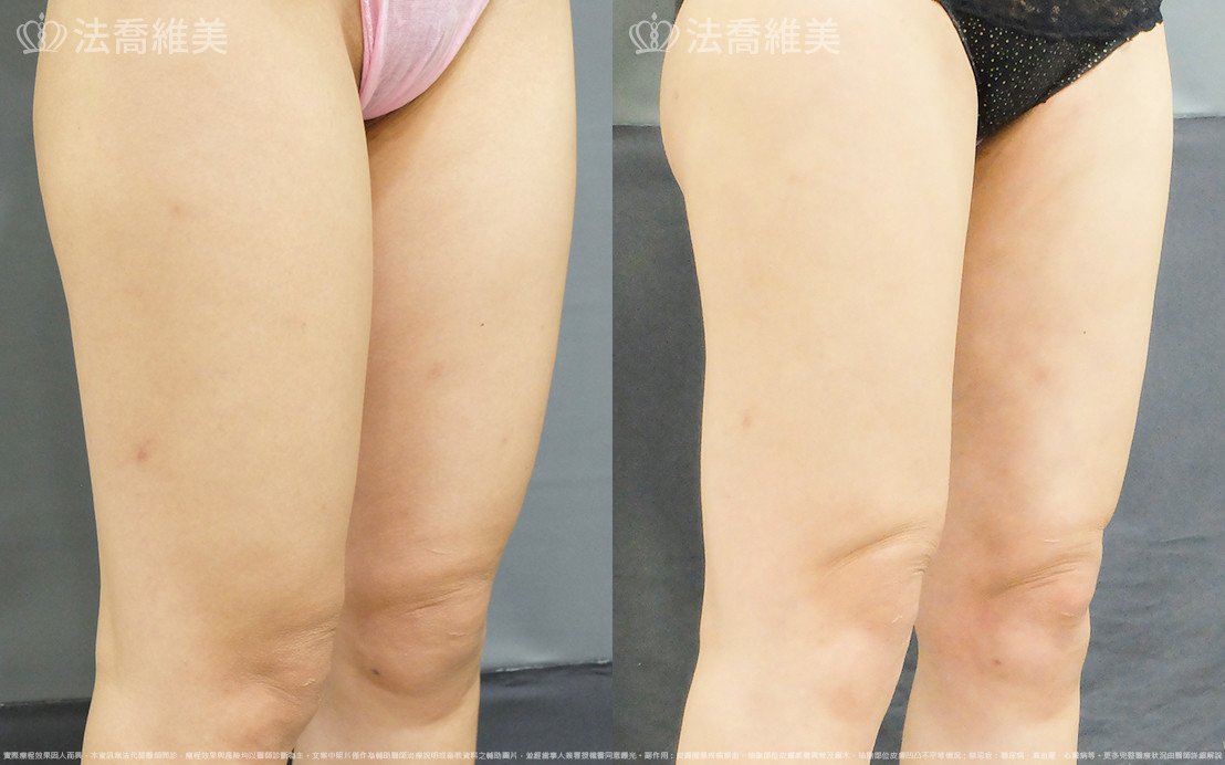 威塑大腿環抽,法喬醫美診所,邱浚彥