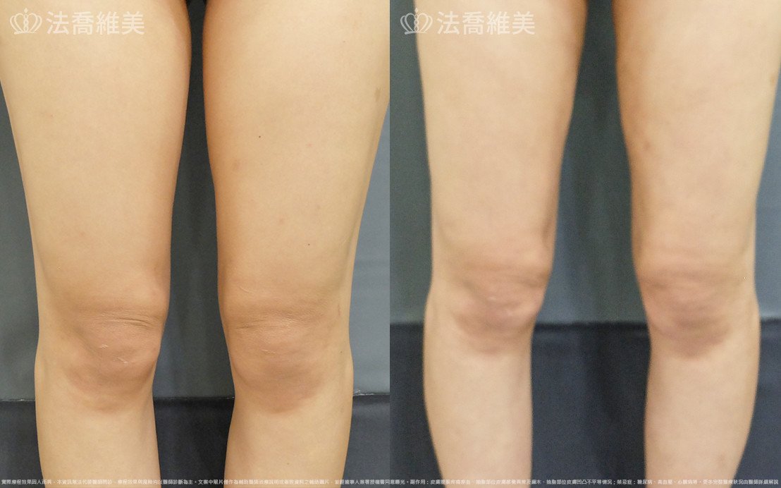 威塑大腿環抽,法喬醫美診所,邱浚彥