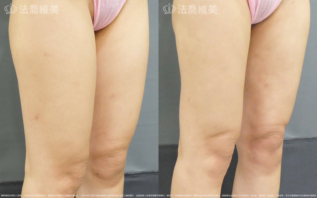 威塑大腿環抽,法喬醫美診所,邱浚彥