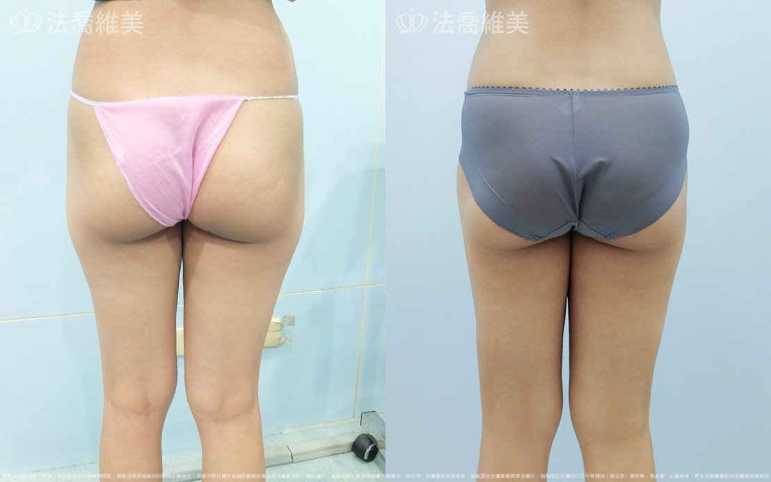 法喬醫美診所,邱浚彥,大腿外側抽脂
