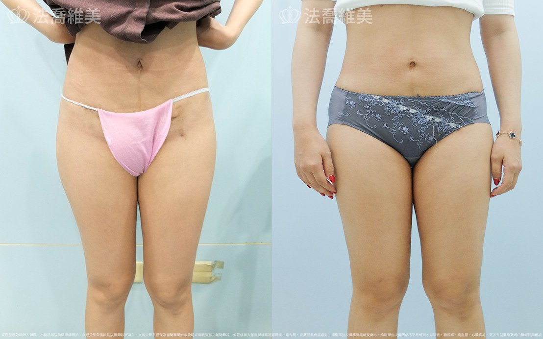 法喬醫美診所,邱浚彥,大腿外側抽脂