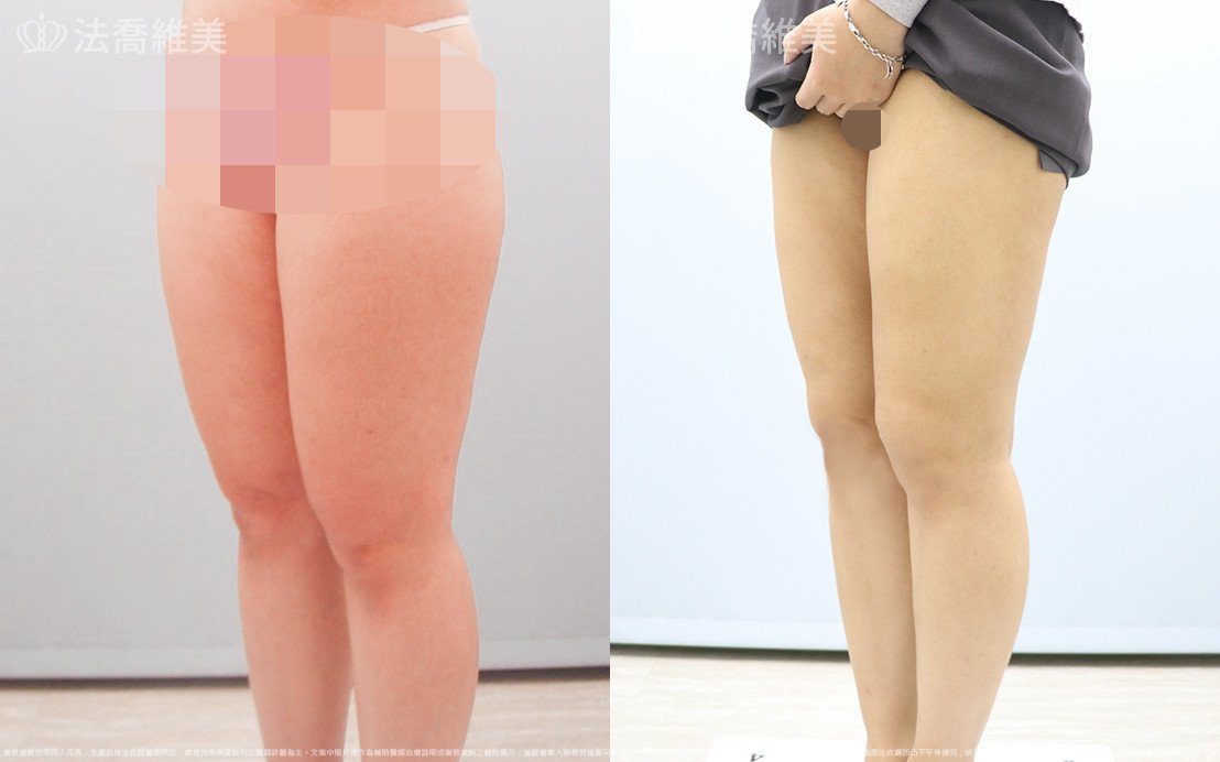 威塑大腿環抽,法喬醫美診所,邱浚彥