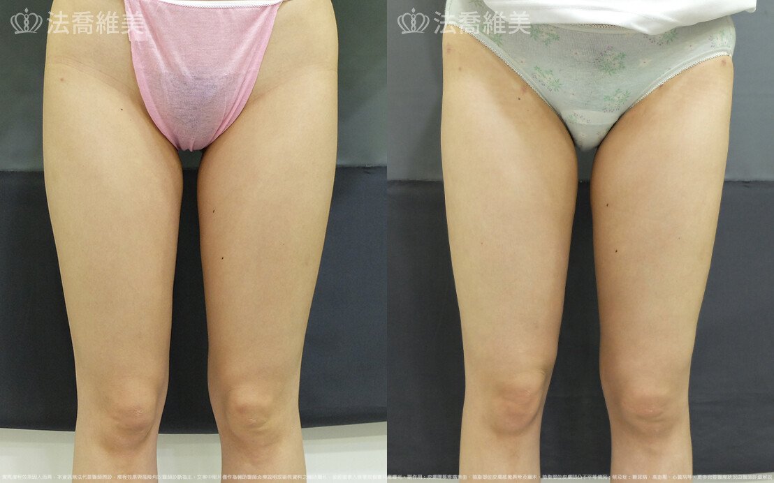 威塑大腿環抽