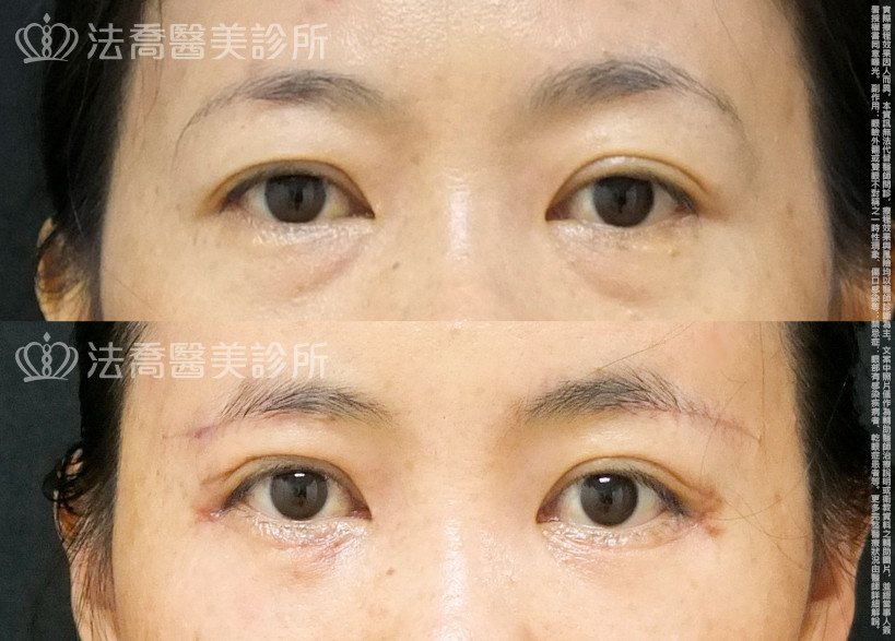 法喬醫美診所,邱浚彥,自體脂肪豐全臉,切眉,眼袋外開