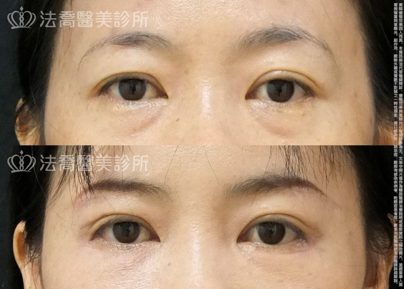 法喬醫美診所,邱浚彥,自體脂肪豐全臉,切眉,眼袋外開